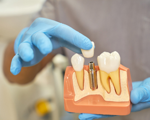 dental-implants