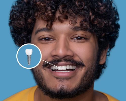 smiley-dental-implant-mobile