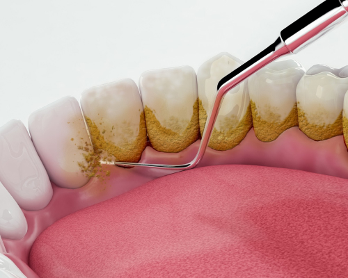 Periodontal-Therapy-mobile