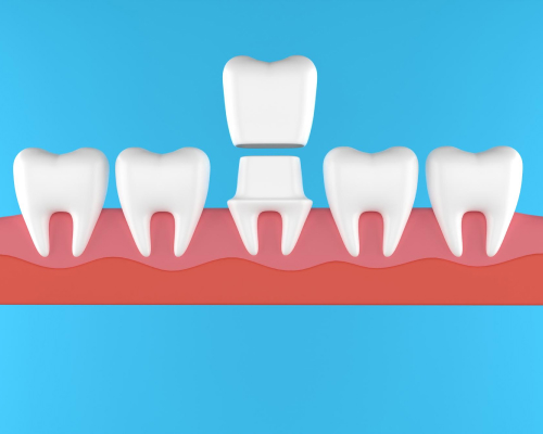 crown-and-bridges-mobile