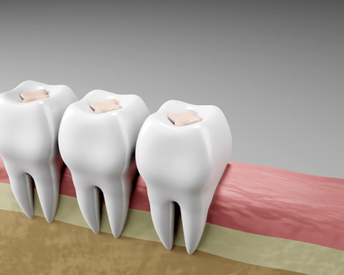 dental-sealants-mobile