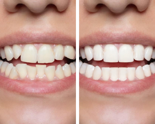 full-mouth-recognisation-mobile