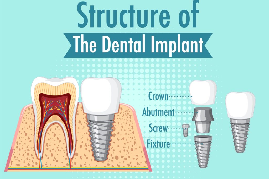 Structure of a dental implant showing crown, abutment, screw, and fixture in the jawbone