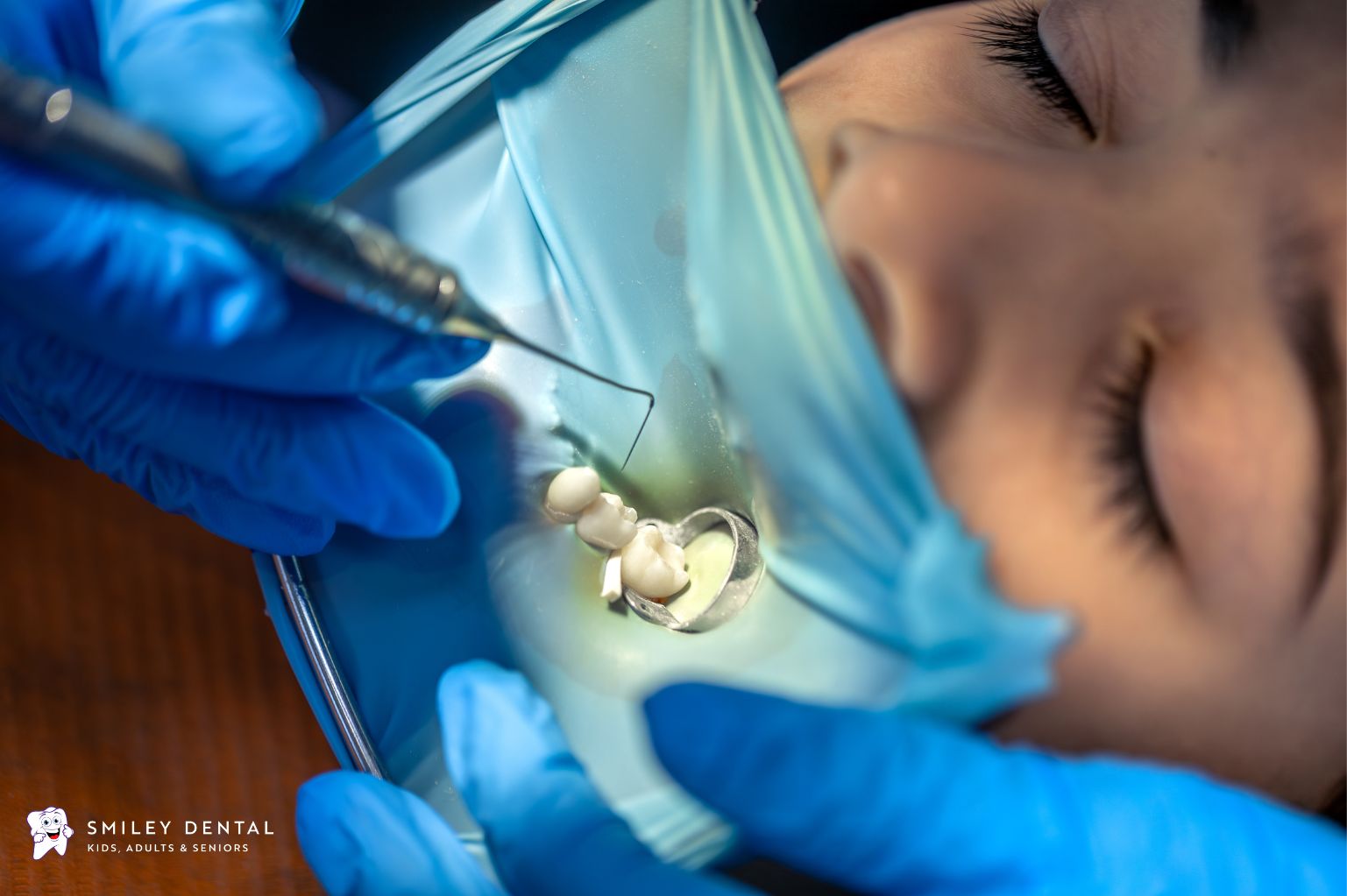 dentist placing a dental filling during a restorative procedure